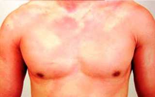 Крапивница у взрослых — провоцирующие факторы и лечебные меры