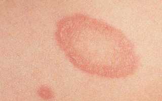 Причины появления и основы лечения белых пятен на спине