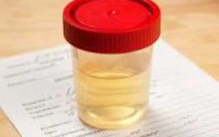 По общему анализу мочи можно определить беременность. Можно ли по общему анализу мочи определить беременность