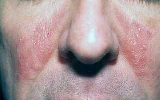 Что делать женщине, если у нее жирная кожа, прыщи и черные точки