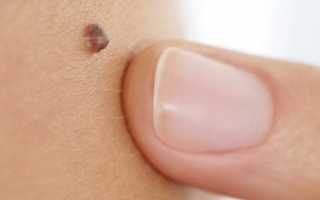 Салициловые пластыри для удаления бородавок для детей и взрослых