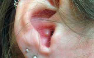 Что делать, если вскочил фурункул (прыщ) в ухе и болит, лечение в домашних условиях