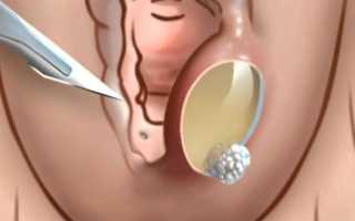 Прыщ на интимном месте (зоне) — у женщин и мужчин, гнойный, вскочил, фото, причины, зуд