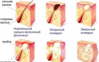 Прыщи на скулах и под скулами: причины появления и рекомендации по лечению