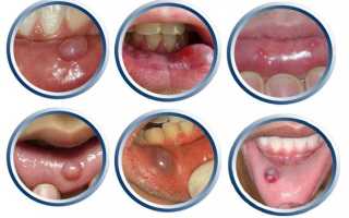Прозрачный пузырек на внутренней стороне щеки. Причины и способы лечения пузырьков во рту