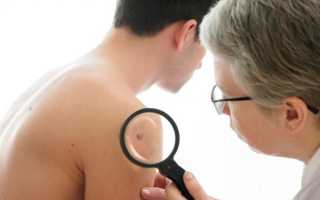 Быстрое, безопасное и безболезненное удаление папиллом лазером