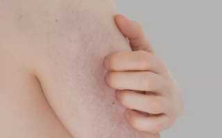 Красные точки на верхней части руки. Красные точки на руках: причины их появления и способы удаления. Красные точки на руках выше локтя