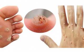 Как вытащить бородавку с корнем: консервативно в домашних условиях