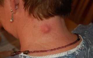 Как избавиться от жировика на лбу: методы лечения и удаления