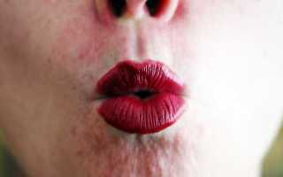 Как лечить герпес на лице при разных типах герпесвируса — самый правильный подход
