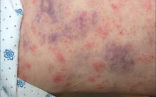 Рак кожи: фото, симптомы, первые признаки 331233 12