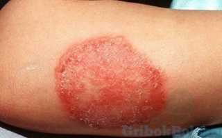 В чем опасность лишая для человека: виды и лечение