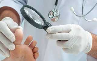 Что такое шипица, как происходит заражение? Препараты и иные способы лечения недуга