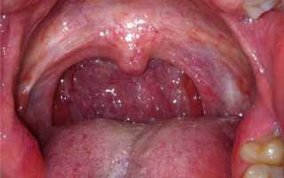 Что значит белый налет на корне языка? Причины и лечение симптомы