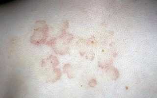 Почему возникает кольцевидная эритема, симптомы заболевания и принципы лечения