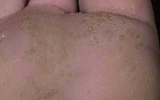 Почему появляются дырочки на ступнях ног? Симптомы и методы лечения