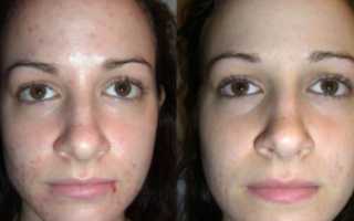 Газожидкостный пилинг лица: что это такое, как проводится, отзывы после процедуры