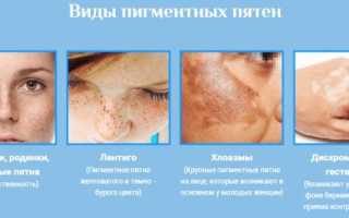 Ахромин от пигментных пятен: чем болгарский крем времён СССР отличается от современных