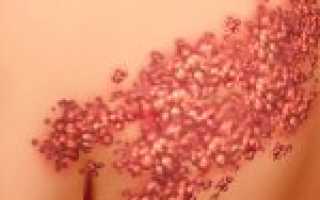 Причины появления и методы лечения герпеса на спине