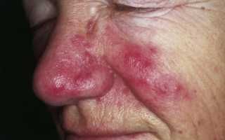 Красное пятно на переносице у взрослого лечение. Как самостоятельно убрать пигментное пятно на носу