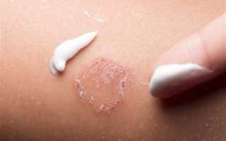 Если обнаружен отрубевидный лишай каково его лечение яблочным уксусом