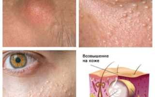 Как избавиться от жировика на веке: проверенные домашние методы