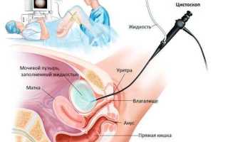 Стент в мочеточнике и почке — для чего ставят