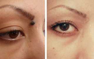 Синий (голубой) невус Ядассона-Тиче: причины и способы удаления