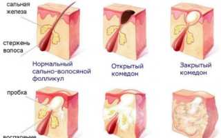 Пилинг для кожи головы – это мастхэв! Домашние и профессиональные средства