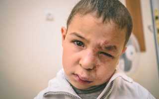 Гемангиома у ребенка — что это, виды, причины, удаление