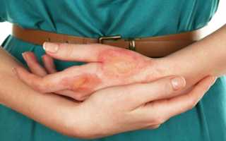 Чем лечить ожог уксусом в домашних условиях на пальцах