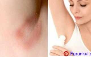 Фурункул (чирей) под мышкой: 10 причин, фото, 5 способов как лечить, профилактика