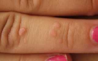 Папилломы: виды, причины появления, особенности диагностики и лечения