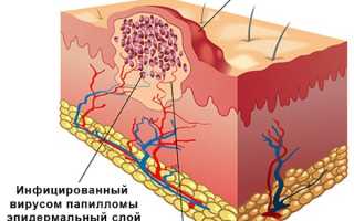 Почему образуются жировые шарики под кожей и как от них избавиться