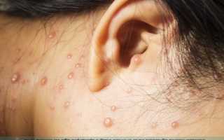 Ветрянка у взрослых — симптомы и лечение, чем опасно заболевание