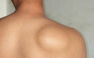 Как вывести жировик на лице и на теле в домашних условиях причины появления жировиков и способы их удаления аптечными и народными средствами