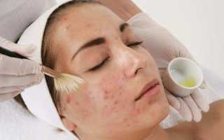 Химический пилинг лица – отзывы клиентов и нюансы процедуры