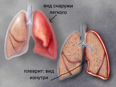 Что если болит правый бок и отдает в спину
