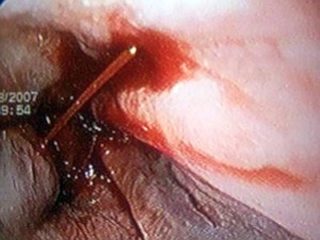 Болит спина в области ребер справа при движении