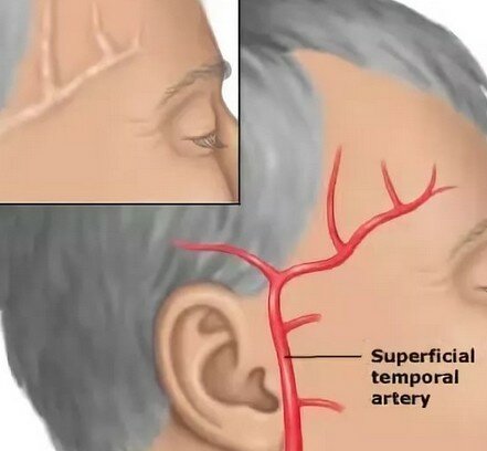 Почему болит голова давит правый висок