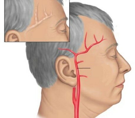 Болит левый висок головы и глаз что это может быть
