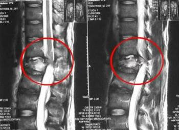Болит позвоночник при наклоне головы вниз