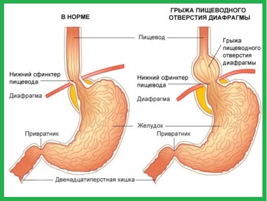 Грыжа пищевода