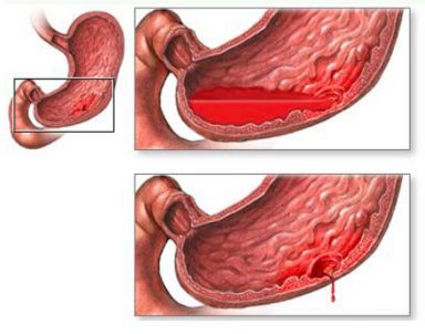 почему болит спина чуть ниже лопатки