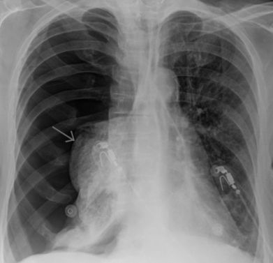 Что если болит правый бок и отдает в спину