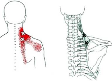 почему болит спина чуть ниже лопатки