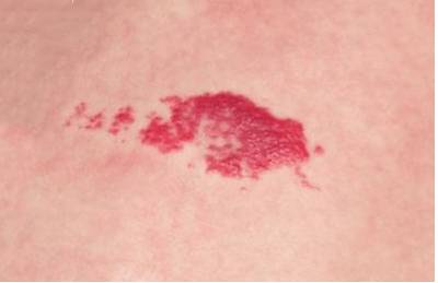 почему болит спина чуть ниже лопатки