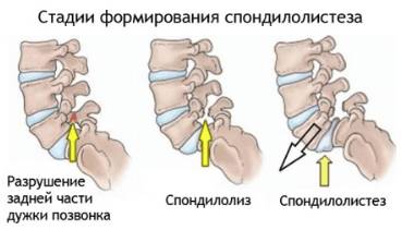 Боли в спине весь позвоночник болит ночью