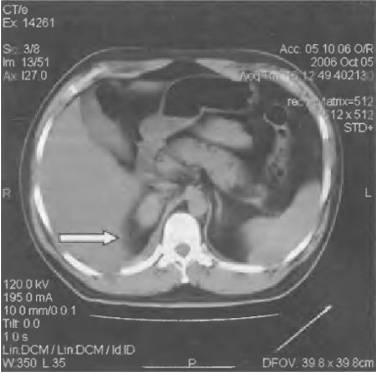 Что если болит правый бок и отдает в спину