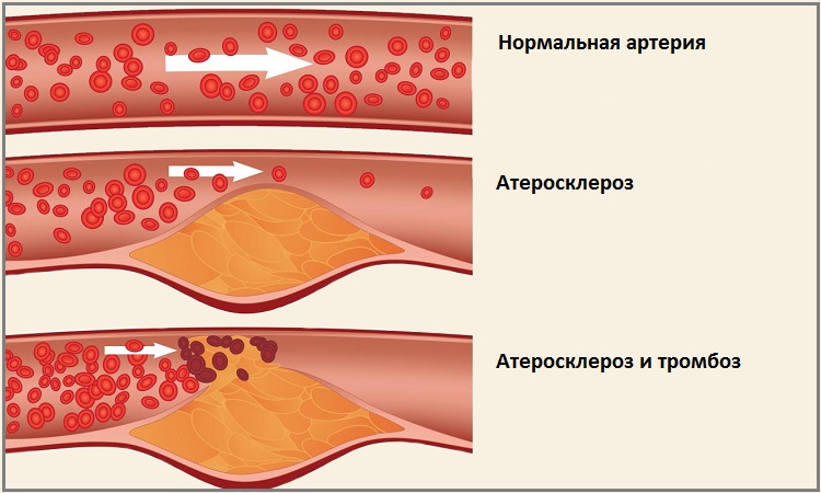 Атеросклероз Атеросклероз
